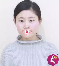 自从在韩国娜娜做下颌角整形国字脸也能轻松变上镜v字脸