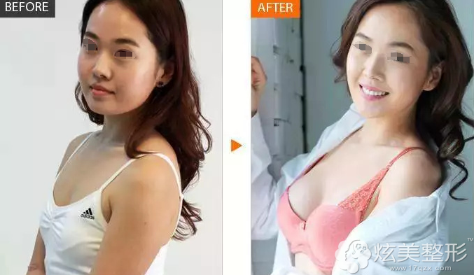 李公昌隆胸案例 李公昌隆胸案例