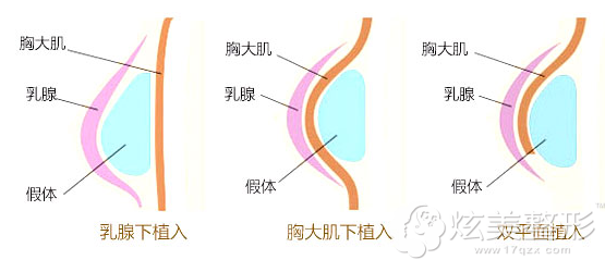 双平面假体隆胸植入技术 双平面假体隆胸植入技术