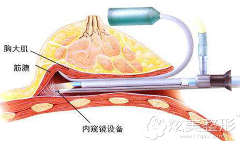 内窥镜直视术 内窥镜直视术
