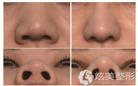 韩春秀医生瘦脸除皱缩鼻头案例 韩春秀医生瘦脸除皱缩鼻头案例