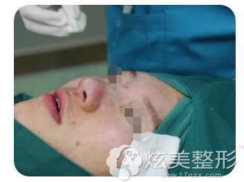 刚做完鼻综合术后效果 刚做完鼻综合术后效果