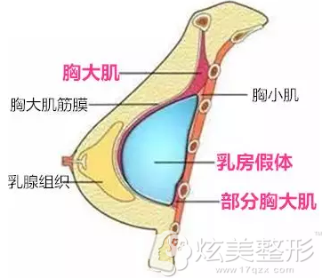 双平面丰胸假体放置位置 双平面丰胸假体放置位置