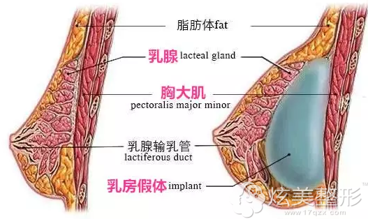 乳腺后间隙假体植入法隆胸 乳腺后间隙假体植入法隆胸