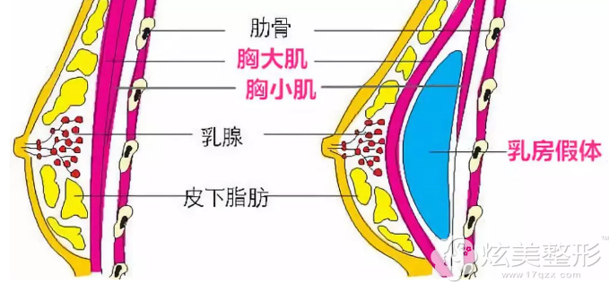胸大肌后间隙假体植入法隆胸 胸大肌后间隙假体植入法隆胸