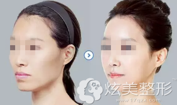 余东文主任自体脂肪填充面部案例 余东文主任自体脂肪填充面部案例