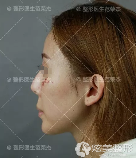 注射微晶瓷隆鼻导致鼻短鼻歪 注射微晶瓷隆鼻导致鼻短鼻歪