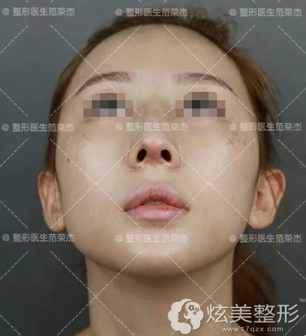 隆鼻后仰视角度看两侧鼻孔大小不一 隆鼻后仰视角度看两侧鼻孔大小不一