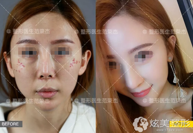 在上海首尔丽格做隆鼻失败修复案例 在上海首尔丽格做隆鼻失败修复案例