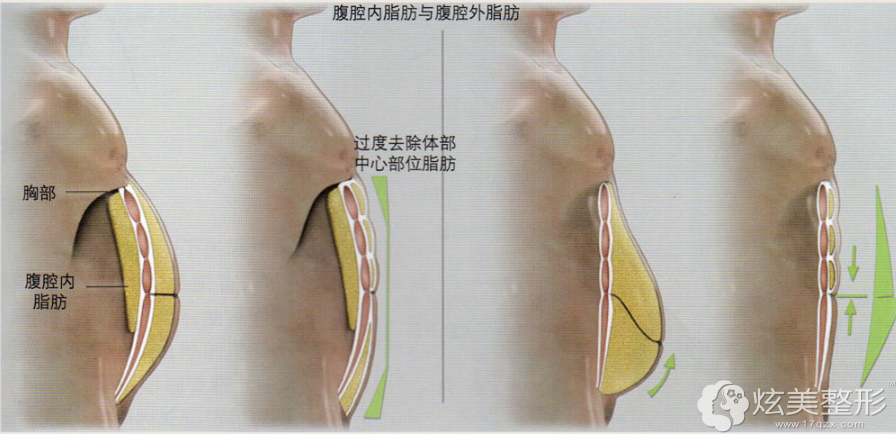 周兴亮院长吸脂 周兴亮院长吸脂