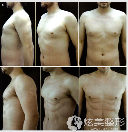 周兴亮教授吸脂案例 周兴亮教授吸脂案例