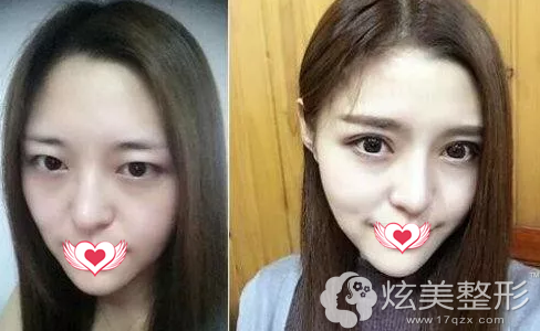 鹏爱鼻综合整形对比图 鹏爱鼻综合整形对比图