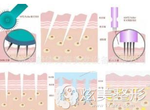 陈立新主任微针美肤原理图解 陈立新主任微针美肤原理图解