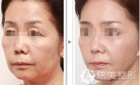 线雕提升除皱前后对比 线雕提升除皱前后对比