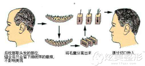 毛发种植原理 毛发种植原理