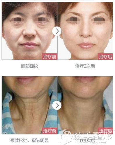 朱海涛除皱前后对比 朱海涛除皱前后对比