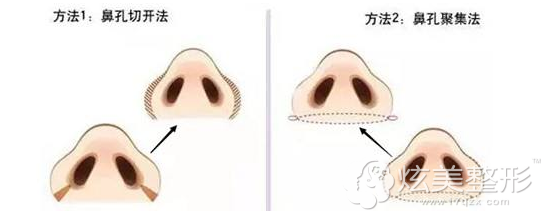 蒜头鼻手术方法 蒜头鼻手术方法