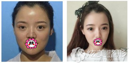 田耿莉瘦脸除皱瘦脸案例 田耿莉瘦脸除皱瘦脸案例
