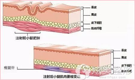注射瘦脸除皱瘦腿效果明显 注射瘦脸除皱瘦腿效果明显
