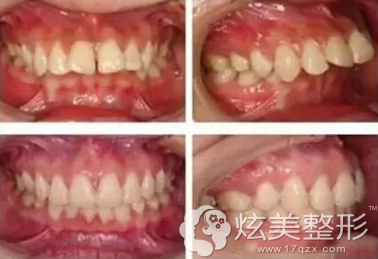 人的牙齿畸形的程度不同价格有所差异 人的牙齿畸形的程度不同价格有所差异