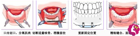 垫下巴示意图 垫下巴示意图