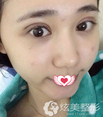刚做完眼综合双眼皮微肿 刚做完眼综合双眼皮微肿
