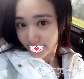 术后1个月双眼皮恢复自然 术后1个月双眼皮恢复自然