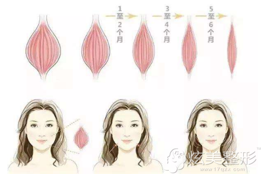 瘦脸的效果维持 瘦脸的效果维持