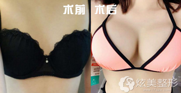袁国材院长自体脂肪丰胸<span style= 袁国材院长自体脂肪丰胸<span style=
