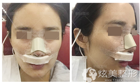 假体隆鼻失败修复术后第二天恢复 假体隆鼻失败修复术后第二天恢复