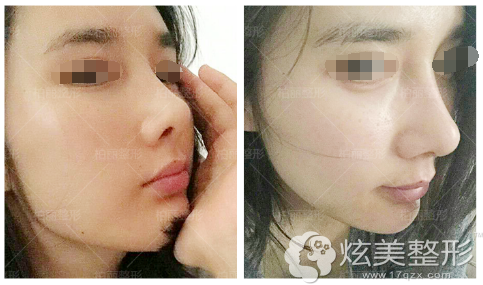 隆鼻失败修复术后一周拆线 隆鼻失败修复术后一周拆线