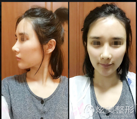 李劲良医生修复隆鼻失败术后恢复 李劲良医生修复隆鼻失败术后恢复