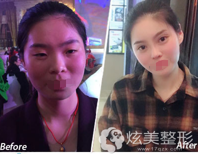 钱宁医生眼整形案例