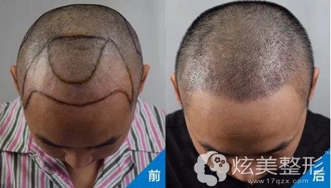 廖小飞医生植发案例 廖小飞医生植发案例