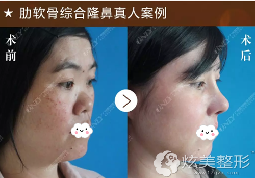 肋软骨隆鼻15天鼻子恢复自然 肋软骨隆鼻15天鼻子恢复自然