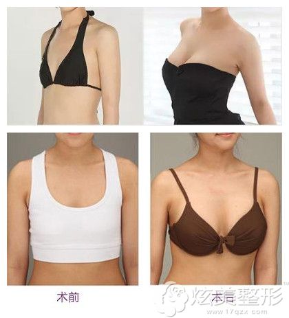 杭州格莱美内窥镜隆胸案例 杭州格莱美内窥镜隆胸案例