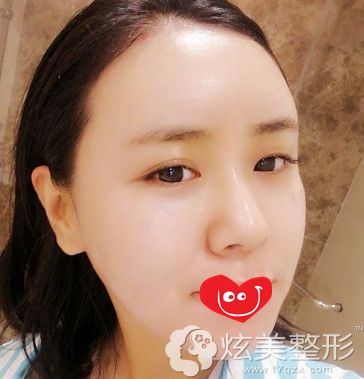 脂肪填充7天后额头变饱满 脂肪填充7天后额头变饱满