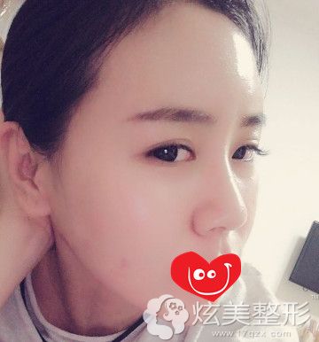 术后16天脂肪有少许吸收 术后16天脂肪有少许吸收