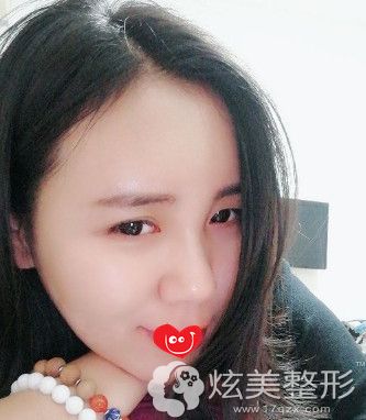 在上海美莱做脂肪填充额头2个月恢复自然 在上海美莱做脂肪填充额头2个月恢复自然