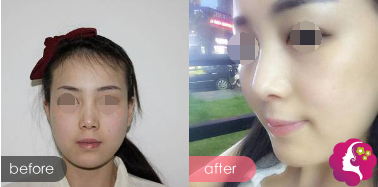 肋软骨隆鼻案例 肋软骨隆鼻案例