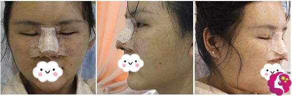 刚做完鼻综合整形手术 刚做完鼻综合整形手术