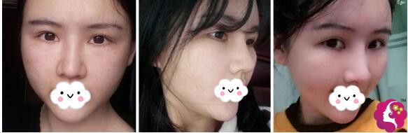 做完鼻综合术后十天恢复 做完鼻综合术后十天恢复