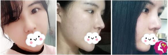 在杭州美莱做鼻综合术后一个月恢复 在杭州美莱做鼻综合术后一个月恢复