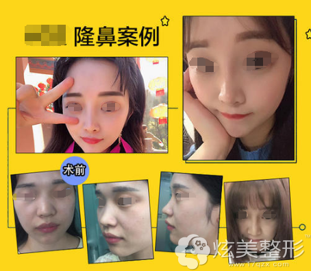 叶艳利隆鼻案例 叶艳利隆鼻案例