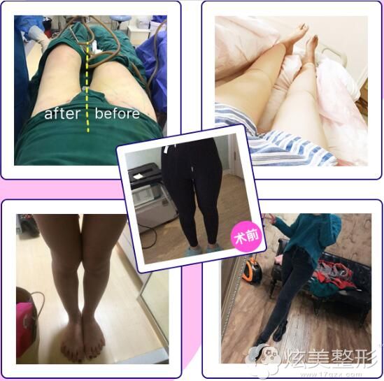 常双模吸脂案例 常双模吸脂案例