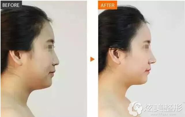 陈瑞雄隆鼻案例 陈瑞雄隆鼻案例