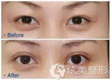 陈鸿主任做眼综合手术案例 陈鸿主任做眼综合手术案例
