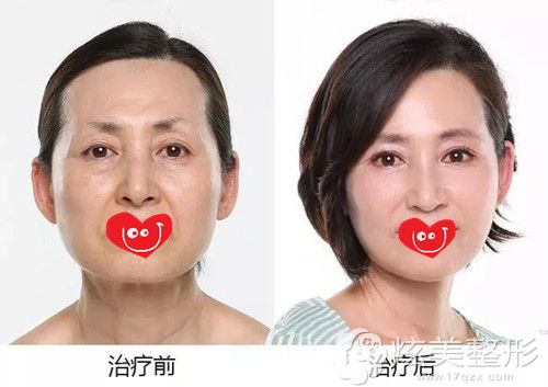 杨美燕主任做除皱案例 杨美燕主任做除皱案例