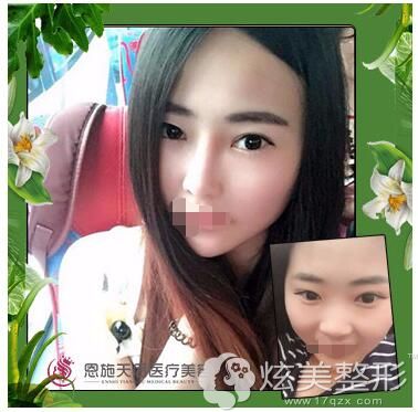 朱继锋眼鼻整形案例 朱继锋眼鼻整形案例