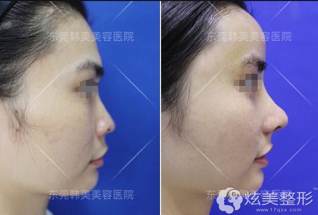 赵扬隆鼻案例 赵扬隆鼻案例